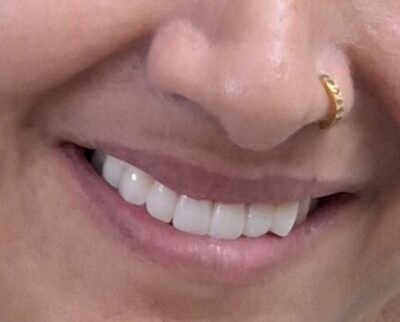 Smile Designing