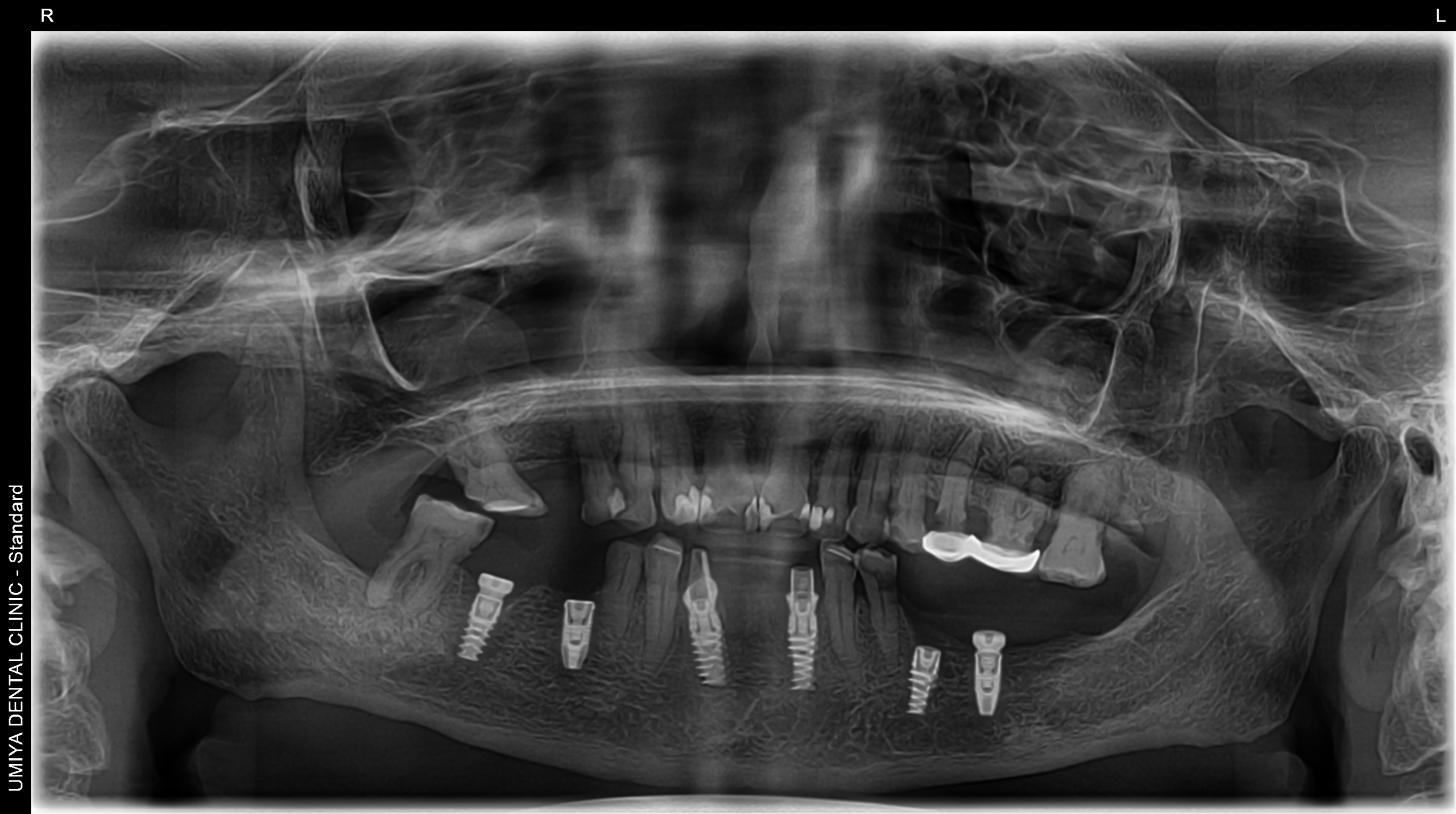 Dental Implants